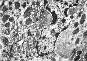 M,38y. | fibrillary astrocytoma M,38y. | fibrillary astrocytoma